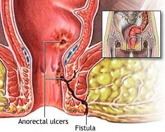 imagini fistula perianala